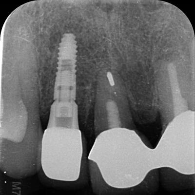 Dental X-Ray Photo